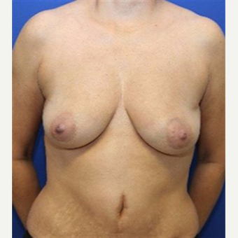 45-54 year old woman treated with Breast Lift before 3037724