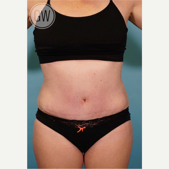 35-44 year old woman treated with Tummy Tuck after 3016672