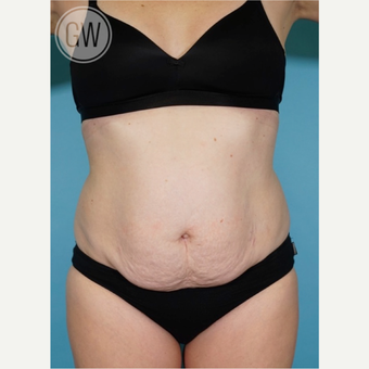 35-44 year old woman treated with Tummy Tuck before 3016672