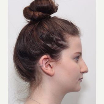 18-24 year old woman treated with Rhinoplasty before 3224920