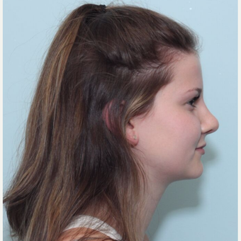 18-24 year old woman treated with Rhinoplasty after 3224920