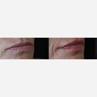 Juvederm Smile on a 34 year old woman. before 3375294