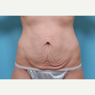 35-44 year old woman treated with Tummy Tuck before 3488329
