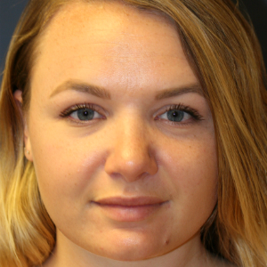 25-34 year old woman treated with Rhinoplasty after 3559750