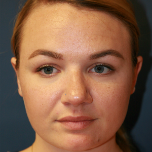 25-34 year old woman treated with Rhinoplasty before 3559750