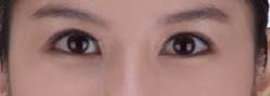Asian Eyelid Surgery after 1223745