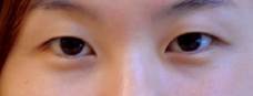 Asian Eyelid Surgery before 1223745