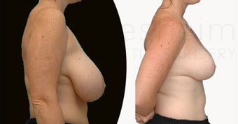 Hanging Large Breast Reduction before 1141935