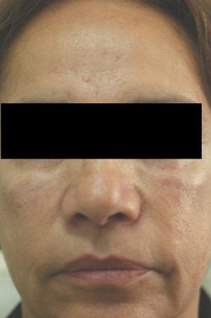 Cheek Shaping with Juvederm Before and After Photos after 204760