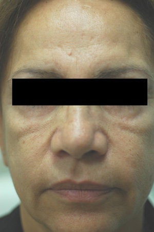 Cheek Shaping with Juvederm Before and After Photos before 204760