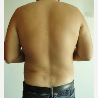 35-44 year old man treated with Vaser Liposuction after 3854258