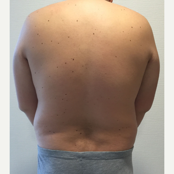 35-44 year old man treated with Vaser Liposuction before 3854258