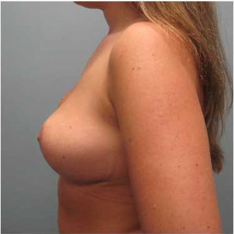 25 year old woman treated with Breast Reduction after 3468141
