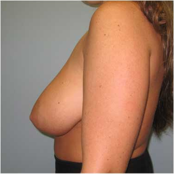 25 year old woman treated with Breast Reduction before 3468141