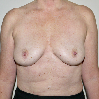 45-54 year old woman treated with Breast Implant Removal after 3579373