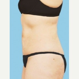 55-64 year old woman treated with CoolSculpting after 2181257