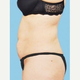55-64 year old woman treated with CoolSculpting before 2181257