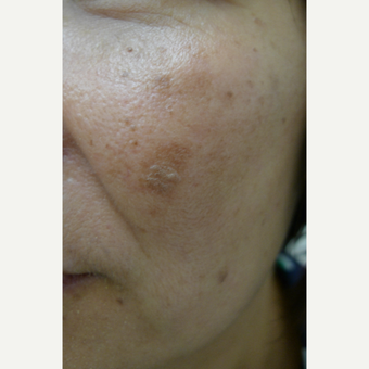 Lasers for age spots before 3125261