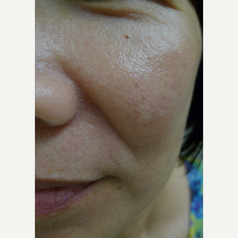 Lasers for age spots after 3125261