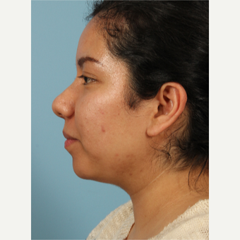 35-44 year old woman treated with Rhinoplasty after 3622687
