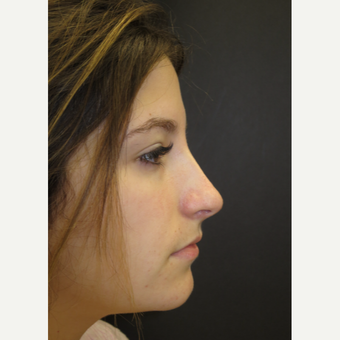 18-24 year old woman treated with Rhinoplasty after 3482558
