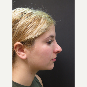 18-24 year old woman treated with Rhinoplasty before 3482558