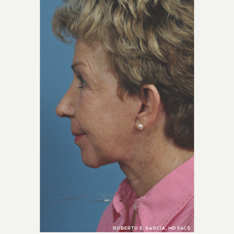 65-74 year old woman treated with Rhinoplasty after 3781633