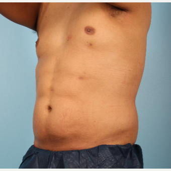 25-34 year old man treated with Abdominal Etching after 3339271