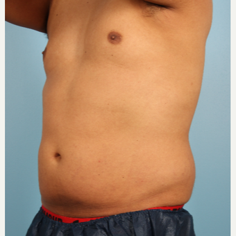 25-34 year old man treated with Abdominal Etching before 3339271