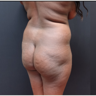 25-34 year old woman treated with Butt Augmentation before 3363829