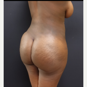 25-34 year old woman treated with Butt Augmentation after 3363829