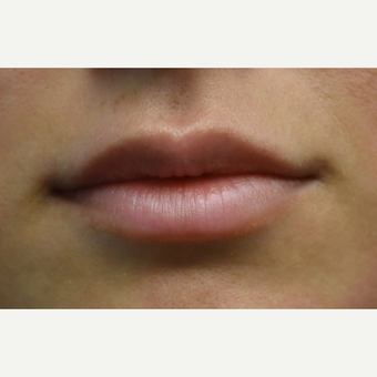 18-24 year old woman treated with Lip Augmentation before 3854696