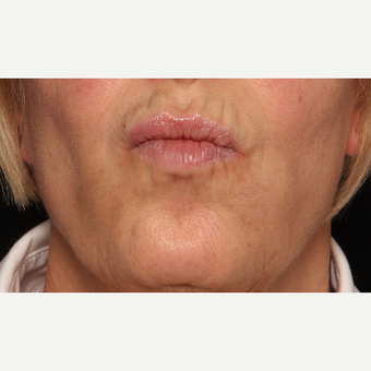 65-74 year old woman treated with Botox after 3520288