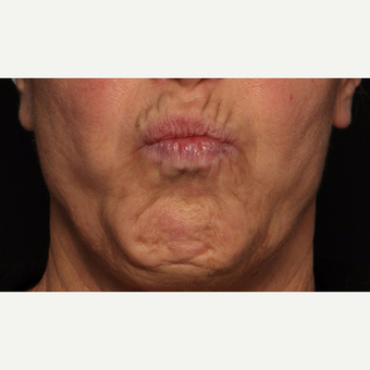 65-74 year old woman treated with Botox before 3520288