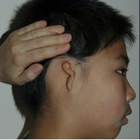 Microtia aka Small Ear by Dr Kasrai, Toronto Female Plastic Surgeon before 894556