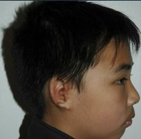 Microtia aka Small Ear by Dr Kasrai, Toronto Female Plastic Surgeon after 894556