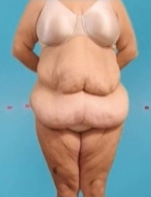 Weight Loss (Massive) & Tummy Tuck before 1076874