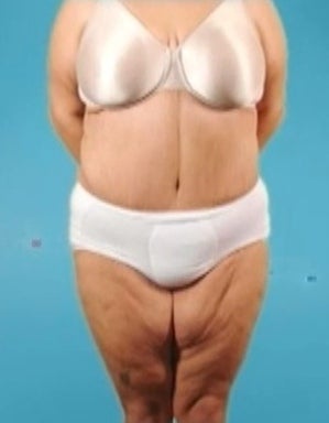 Weight Loss (Massive) & Tummy Tuck after 1076874