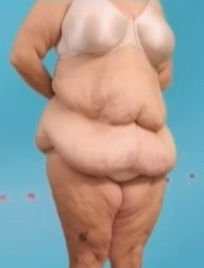 Weight Loss (Massive) & Tummy Tuck 1076874