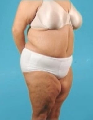 Weight Loss (Massive) & Tummy Tuck 1076874