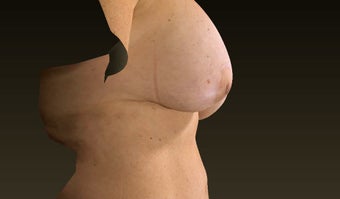 45-54 year old woman treated with Breast Implant Removal and Breast Lift 3563890