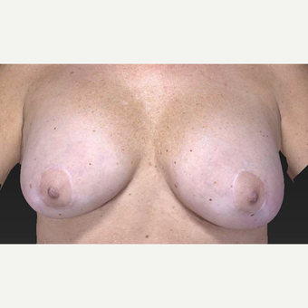 45-54 year old woman treated with Breast Implant Removal and Breast Lift before 3563890