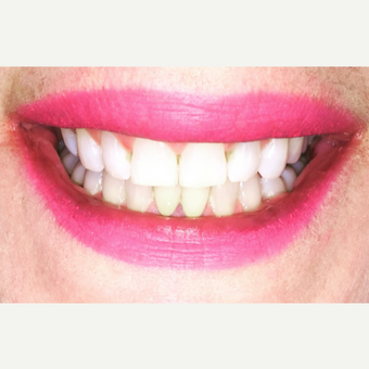45-54 year old woman treated with Botox after 3702530