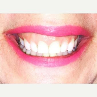 45-54 year old woman treated with Botox before 3702530
