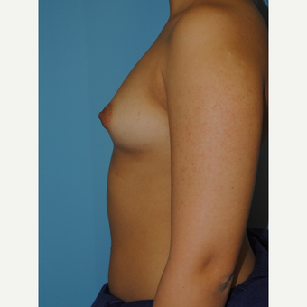 20 Year old with 330 cc Saline high profile implants before 3168665