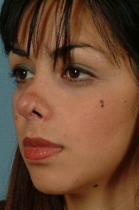 Revision Rhinoplasty before 313093