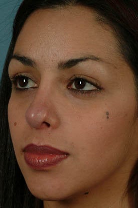 Revision Rhinoplasty after 313093