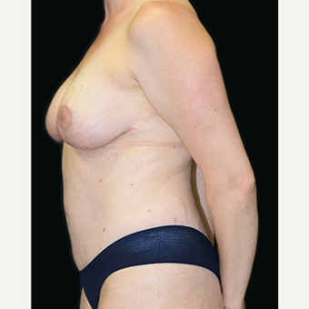 36 year old Mommy Makeover after 3 pregnancies after 3333030
