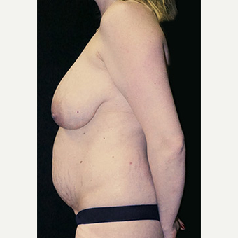 36 year old Mommy Makeover after 3 pregnancies before 3333030