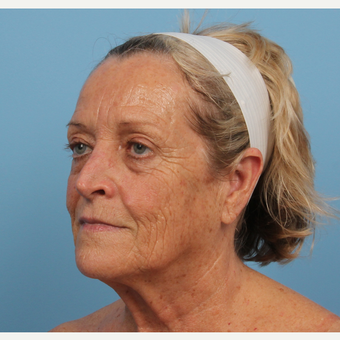 55-64 year old woman treated with CO2 Laser before 3070847